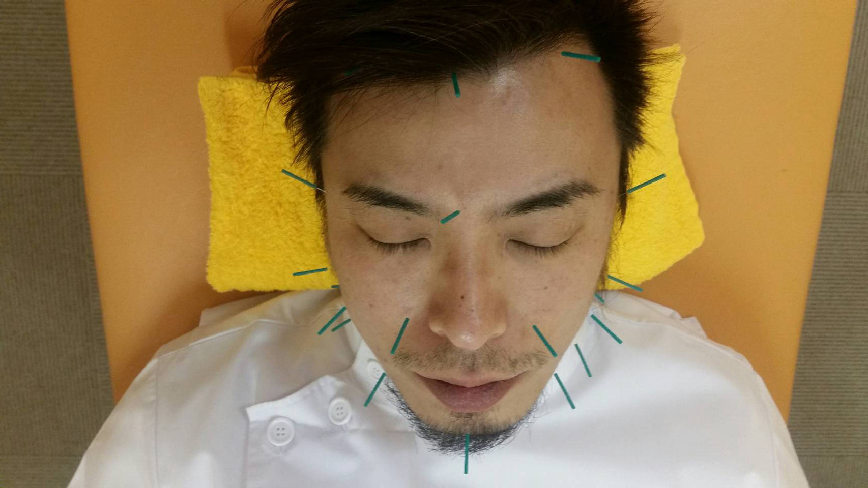 美容鍼