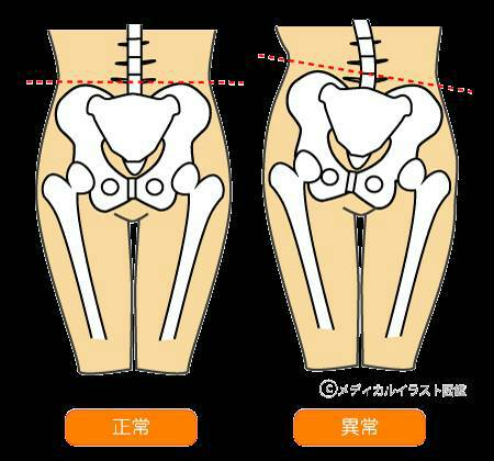 骨盤矯正